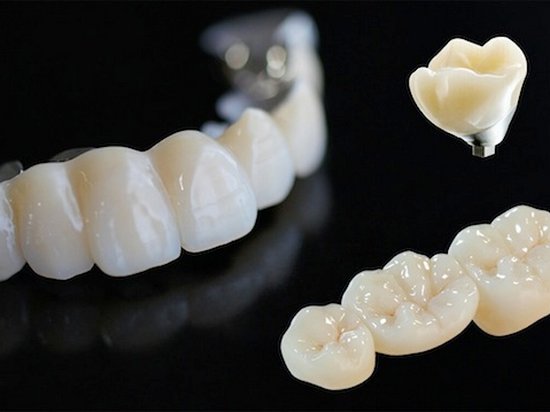 Зубные коронки: какими они бывают
