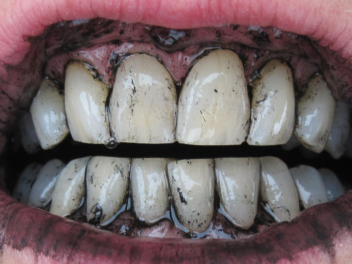 Как отбелить зубы активированным углём?