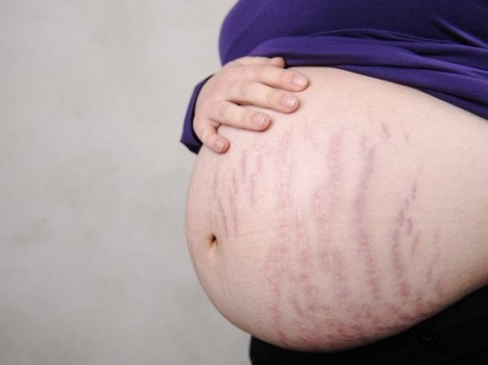 Как избежать появления растяжек во время беременности