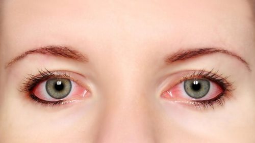 Могут ли контактные линзы вызывать аллергическую реакцию