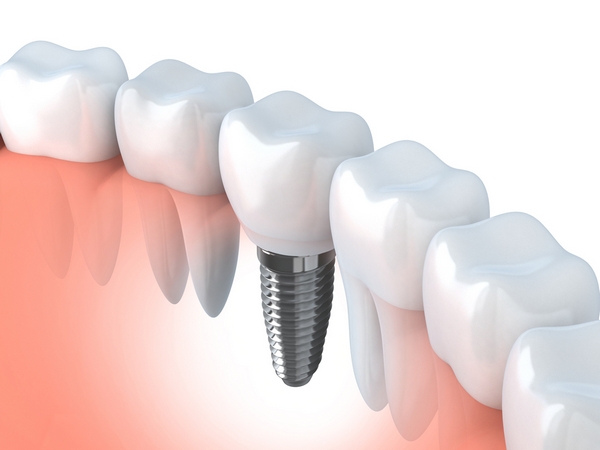 Что такое имплантация зубов и в чем заключаются ее преимущества?