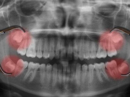 Осложнения при удалении зубов