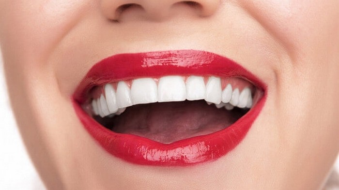 Что такое виниры — плюсы и минусы винирования зубов