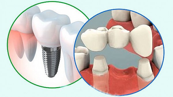 зубной мост или имплант