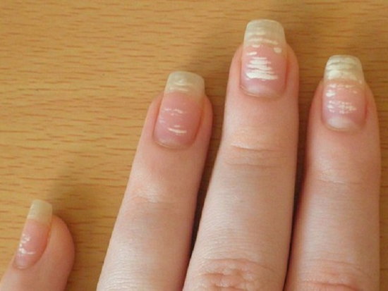 Что означают белые пятна на ногтях и надо ли с ними бороться?