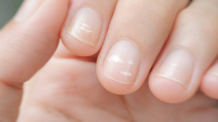 Белые пятна на ногтях: что это означает и как избавиться