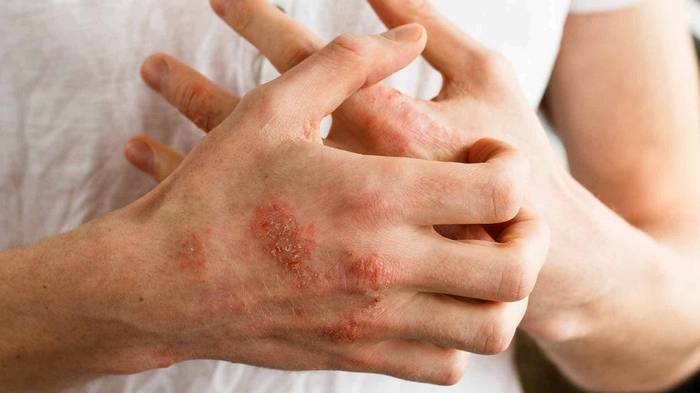 Аллергия на мыло: как определить и что делать