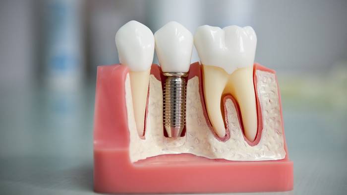 Как восстановить и сохранить костную ткань, если пришлось удалить зуб?