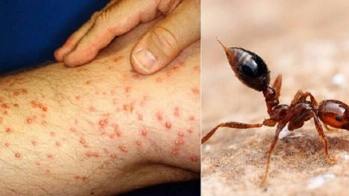 Как отличить укус насекомого от серьезного заболевания? Определяю невооруженным глазом