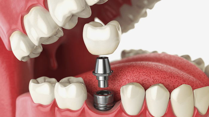 Какие рекомендации можно дать клиентам, которым предстоит протезирование зубов?