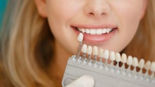 Эффективное отбеливание зубов в домашних условиях: лучше профессиональной чистки