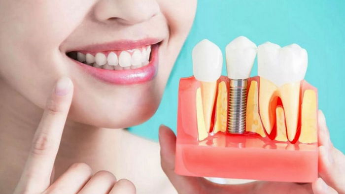 Имплантация — один из ведущих методов восстановления разрушенных зубов
