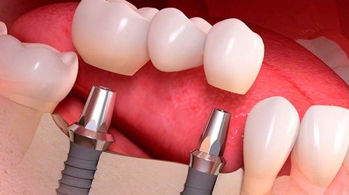 Имплантация для восстановления зубного ряда: все за и против