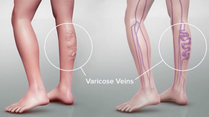 Без «сеточек» и «звездочек»: как спасти ноги от варикоза