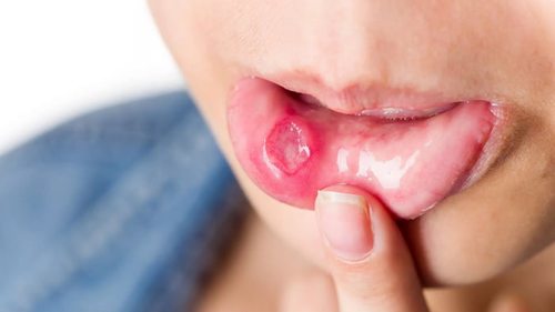 Язвы во рту, лечение язвенных поражений полости рта