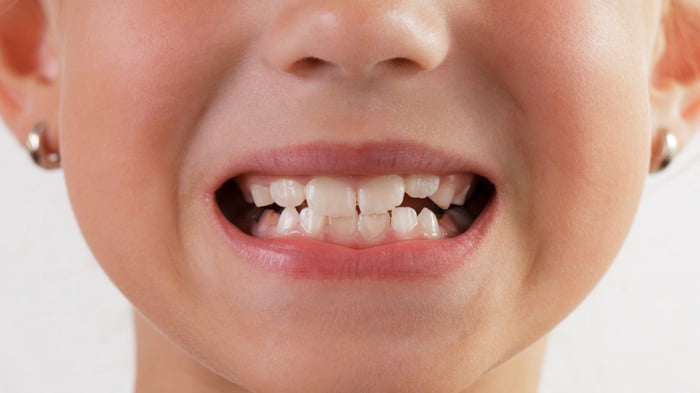 Молочные зубы – уход и профилактика кариеса