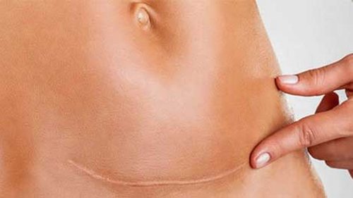 Рубец на матке как фактор осложнения беременности и родов