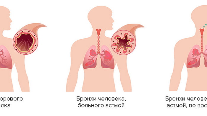 Терапия бронхиальной астмы
