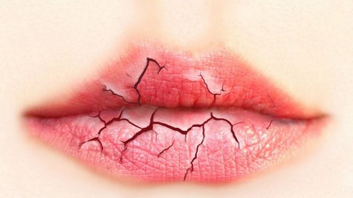 Обветренные губы: народные средства лечения