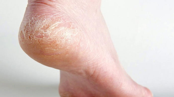 Шелушение кожи на ногах — причины и способ лечения