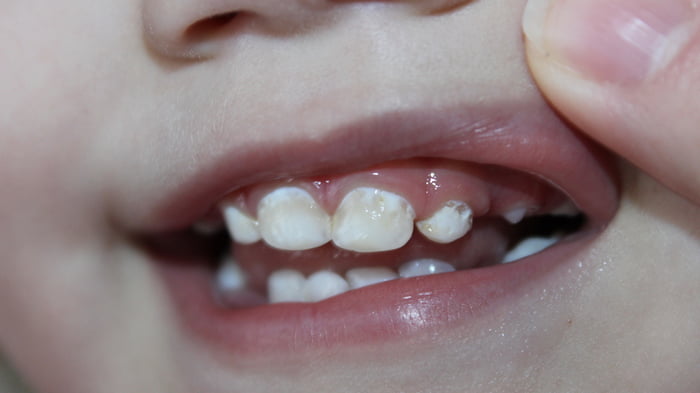 Желтые зубы у детей. В чем причина?