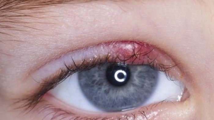 11 народных средств для лечения ячменя на глазу