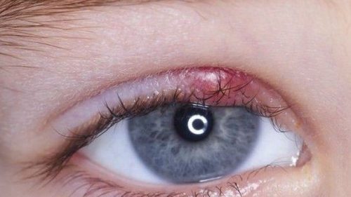 11 народных средств для лечения ячменя на глазу