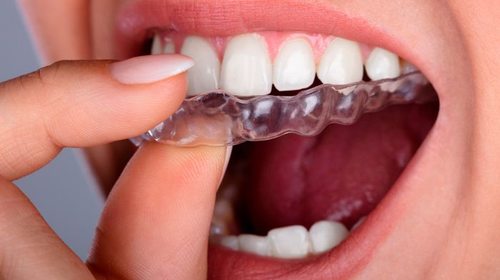Плюси та мінуси відбілювання зубів в домашніх умовах