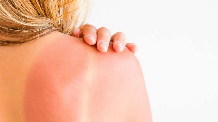 Солнечные ожоги и покраснения кожи: как быстро себе помочь