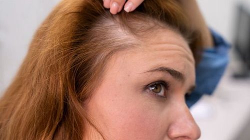 Норма или патология: стоит ли паниковать, когда выпадают волосы после родов