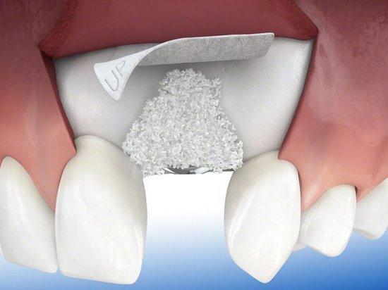 Костная пластика в стоматологии