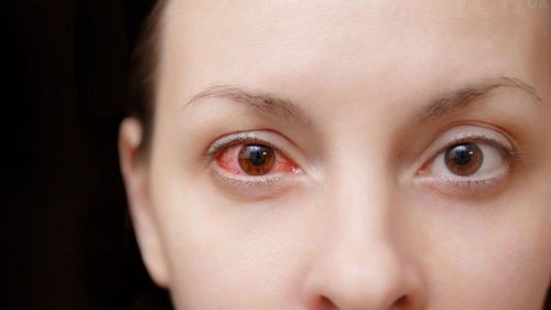 Синдром красного глаза: врач-офтальмолог рассказал о симптомах и первой помощи