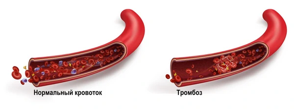 тромбоз