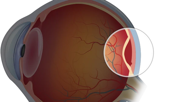 отслоение сетчатки глаз
