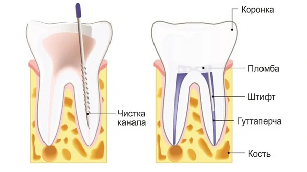 депульпация зуба