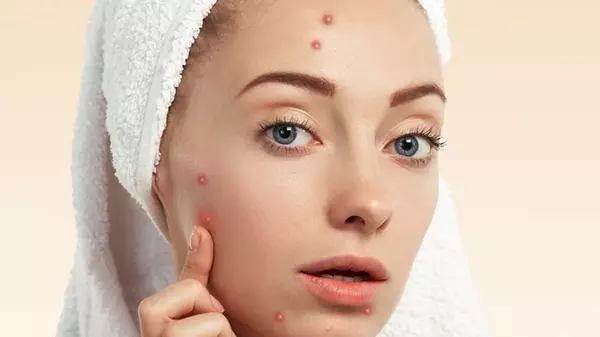 Не делайте так! 6 худших ошибок при появлении прыщей