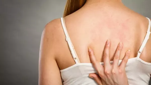 Причины возникновения прыщей на спине и как от них избавиться