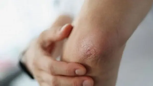 Как избавиться от сухости и трещин на локтях: простые советы для здоровой кожи