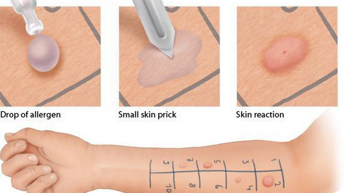 токсидермия