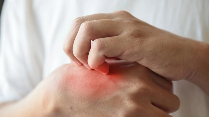 токсидермия