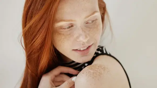 Не только солнце: названы неочевидные причины пигментных пятен