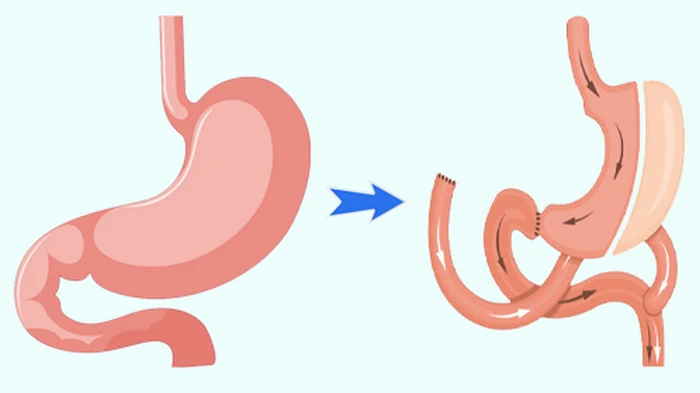 резекция желудка