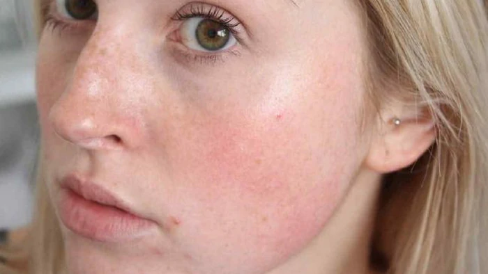 Лицо внезапно краснеет? На это есть 6 причин — и это не всегда аллергия