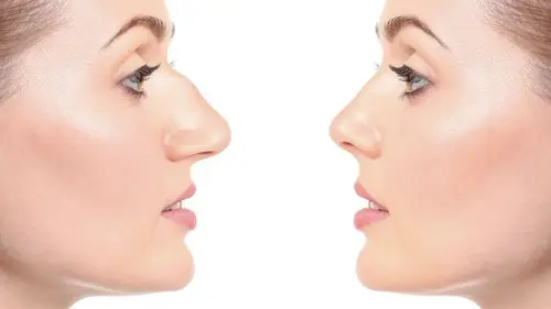 пластика лица