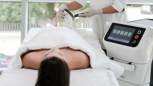 лазерна епіляція