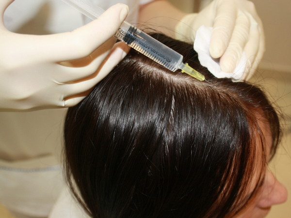 ​Мезотерапия для волос — лечение волос