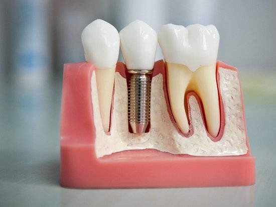 Какой зубной имплант лучше выбрать пожилым людям?