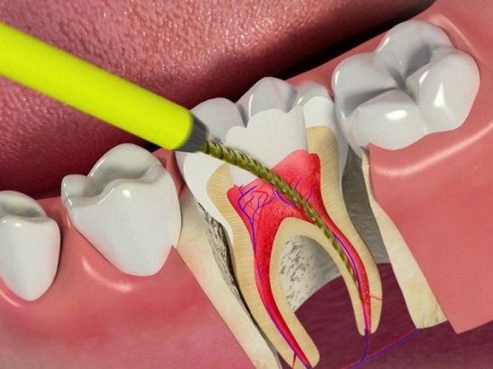 Чистка каналов зуба – возможные осложнения